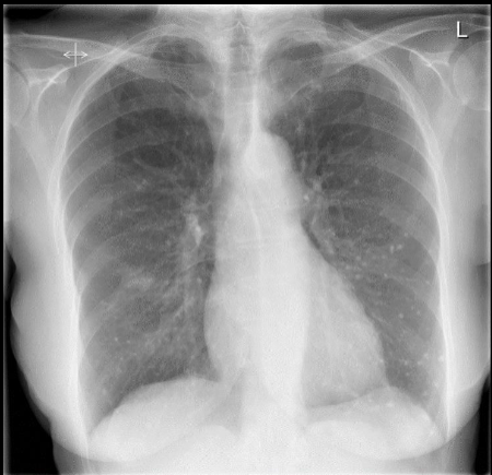 <p><span>Female. 70 years. Persistent</span> <span>and troublesome cough</span></p>