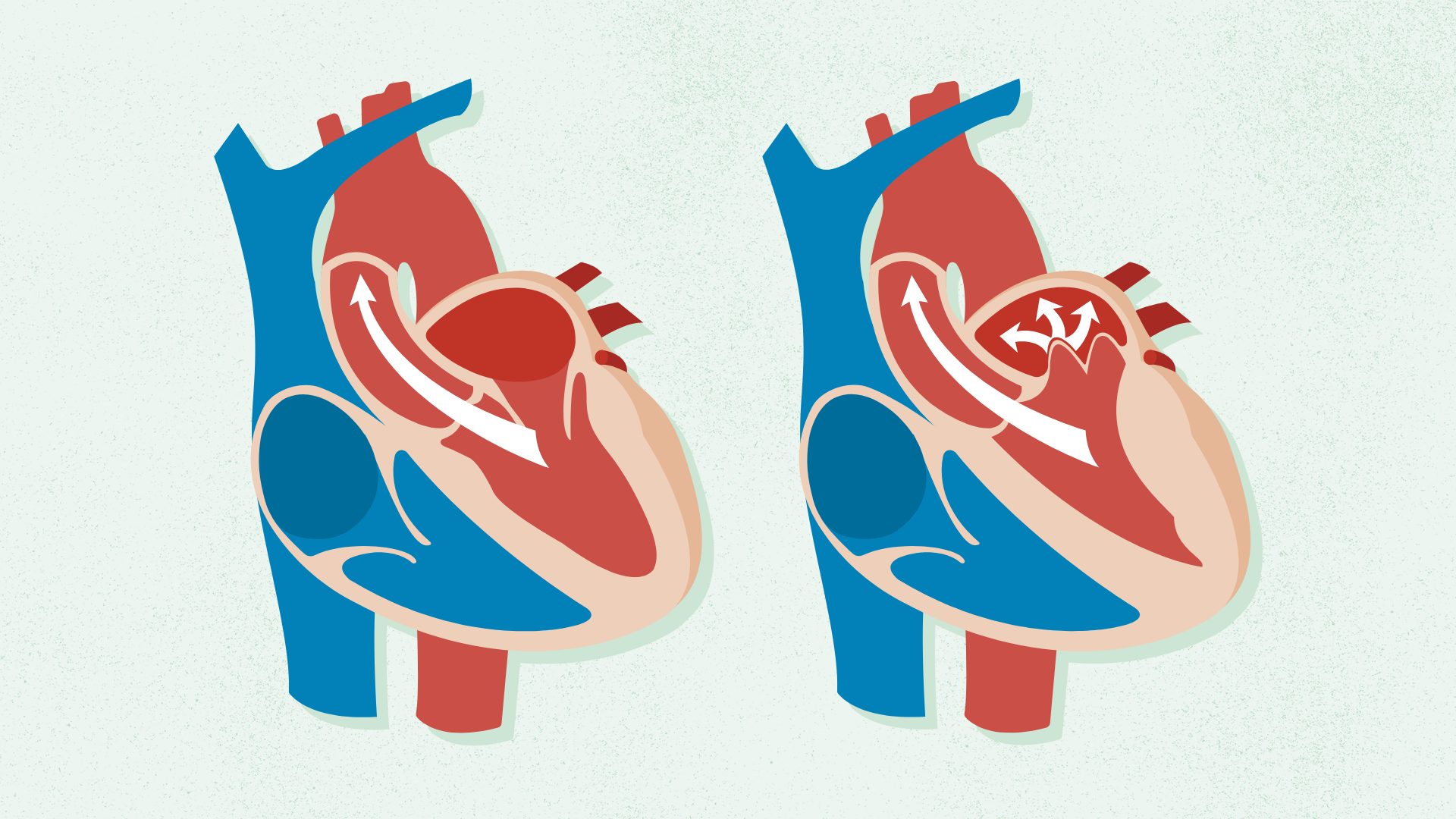 <p><strong>Valvular leaflets enlarge &amp; prolapse into the L atrium during systole (usually benign)…</strong></p><p>i.) Associated w/ Marfan syndrome &amp; familial tendency</p><p>ii.) Normal HR &amp; BP are expected findings <span>→ mid-systolic click &amp; late systolic murmur (at apex) possible</span></p><p>iii.) May progress to <em>mitral regurgitation</em></p>