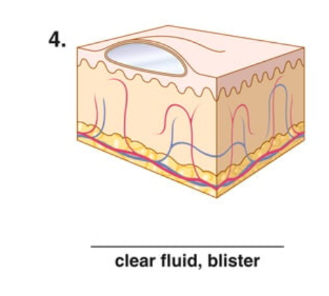 <p>clear fluid, blister</p>