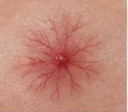 <p><span>Small, central red spot with radiating spider-like capillary legs; characteristically blanches when pressure is applied to the central core (e.g., pregnancy, liver disease)</span></p>