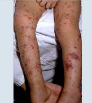 <p><span style="color: rgb(239, 52, 52);"><strong>Petechiae</strong></span>!!!!</p><ul><li><p>means infection reached bloodstream</p></li></ul><p></p>