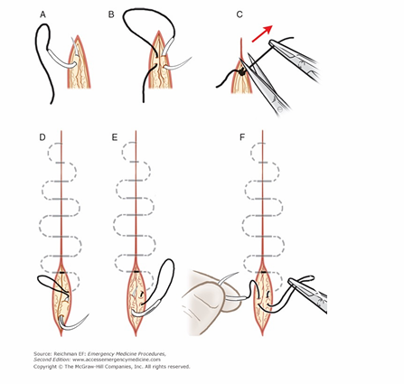 <p>-usually for closing surgical incisions</p><p>-require clean wound edges</p><p>-best cosmetic result</p>