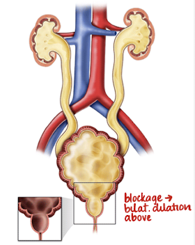 <ul><li><p>obstruction produced by abnormal congenital membrane within posterior urethra</p><ul><li><p>leads to hydronephrosis, hydroureter, bladder dilation, and dilated proximal urethra</p></li></ul></li><li><p>degree of obstruction can be complete, partial, or intermittent</p></li><li><p>MC urethral anomaly</p></li><li><p>occurs only in males (biological)</p></li><li><p>prognosis depends on severity of obstruction </p></li></ul><p></p>