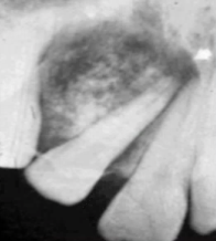 <p>which of the following is NOT in the differential: </p><p>pindborg</p><p>gorlin cyst </p><p>adenomatoid odontogenic tumor </p><p>odontogenic myxoma </p>