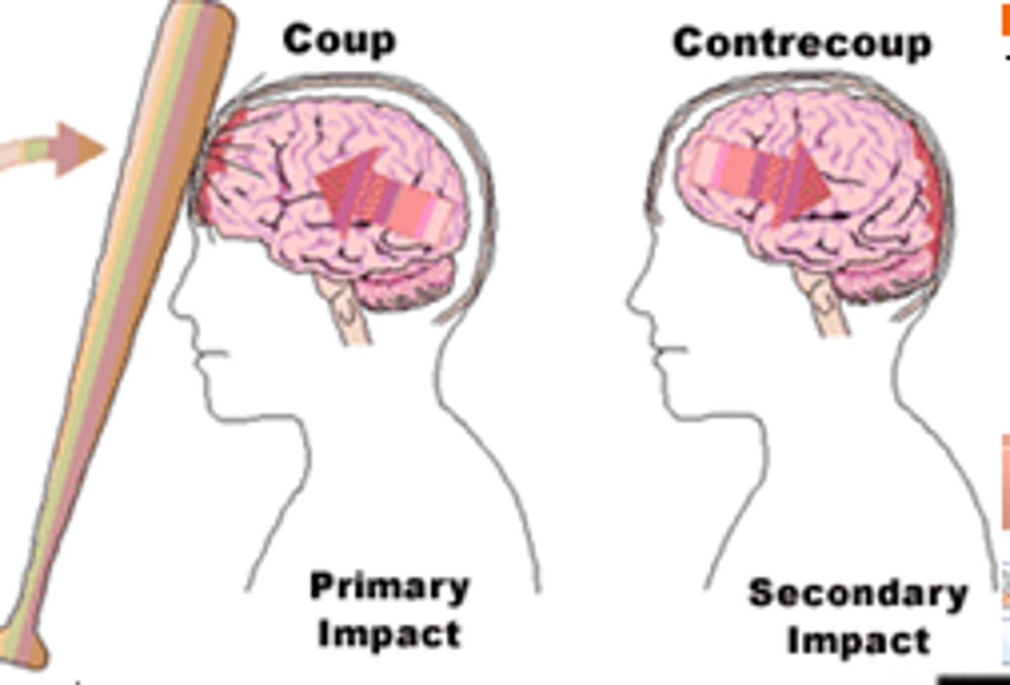 <p>Skull fracture that happens opposite to point of impact</p>