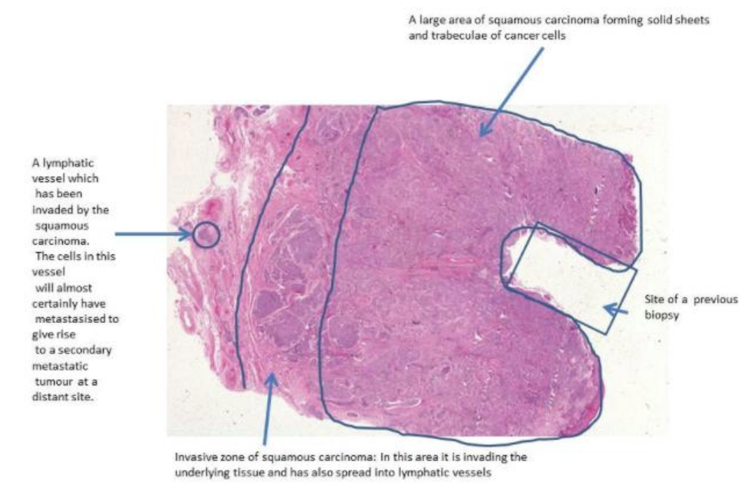 <p>The carcinoma has invaded down from the epithelium deeply into the connective tissue stroma of the cervix, forming islands, tongues, and some solid sheets of cancer cells. Around the deepest invasive edge, the carcinoma has invaded into some lymphatic vessels.</p><p>Metastases might be found in local lymph nodes, if the carcinoma is invading lymphatics.</p>