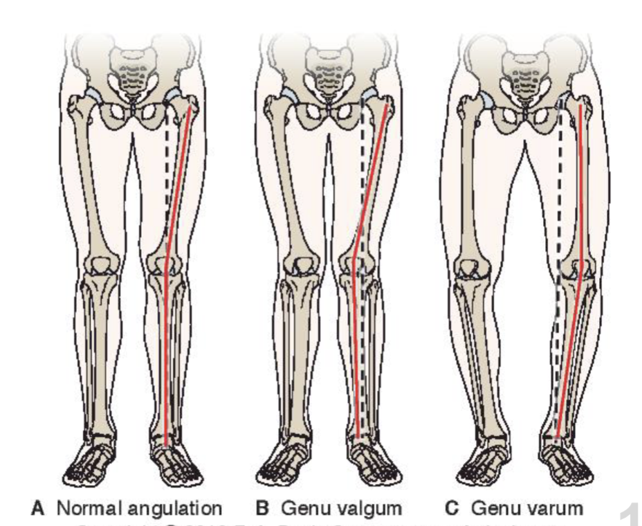 <p><strong>Normal angulation:</strong></p><ul><li><p>some vara </p></li><li><p>femur is more oblique for femoral condyles to be in the same plane</p></li></ul><p></p><p><strong>Genu valgum:</strong></p><ul><li><p>> 180 dg</p></li><li><p>lateral tensile stress</p></li></ul><p></p><p></p><p><strong>Genu vara:</strong></p><ul><li><p>< 180 dg</p></li></ul><ul><li><p>medial compressive stress (hyaline cartilage + meniscus)</p></li></ul><p></p>