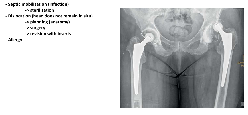 <ul><li><p>septic mobilisation</p></li><li><p>dislocation</p></li><li><p>allergy</p></li></ul><p></p>