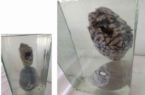 <p>Questions</p><ol><li><p>What is the specimen being examined?</p></li><li><p>What are the type, specific descriptive features, and dimensions of the skull fracture?</p></li><li><p>How is the antemortem nature of the injury determined?</p></li><li><p>What type of causative instrument and cross-sectional shape produce this injury?</p></li><li><p>How is the time of death estimated?</p></li><li><p>What are the possible causes of death?</p></li><li><p>What is the final diagnosis for this specimen?</p></li></ol><div data-type="horizontalRule"><hr></div><p></p>