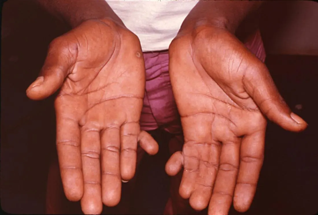 <p>Polydactyly</p>