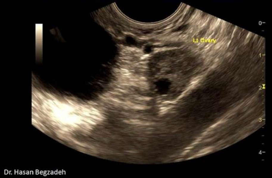 <p>What is the round, anechoic structure demonstrated on the sagittal image of the left adnexa?</p><p>A. urinary bladder</p><p class="p1">B. large nabothian cyst</p><p class="p1">C. pedunculated leiomyoma</p><p class="p1">D. paraovarian cyst</p>