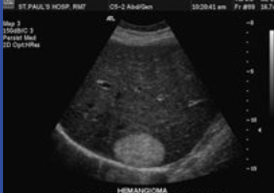 <p>hyperechoic</p>