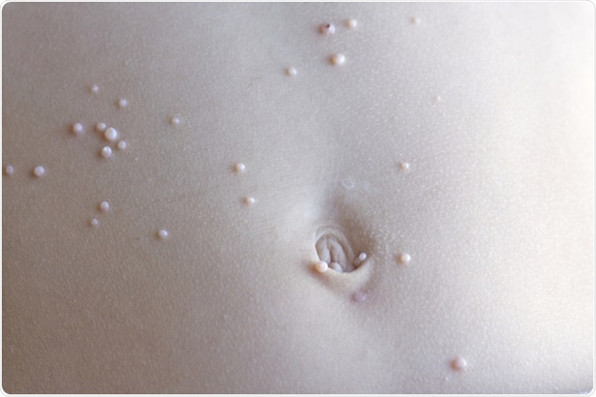 <p>A viral skin infection characterized by small, firm, flesh-colored or pearly bumps with a dimpled center.</p>