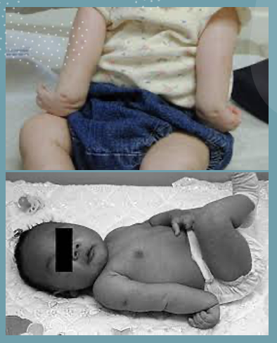 <p>what neurological injury is this picture demonstrating? </p>