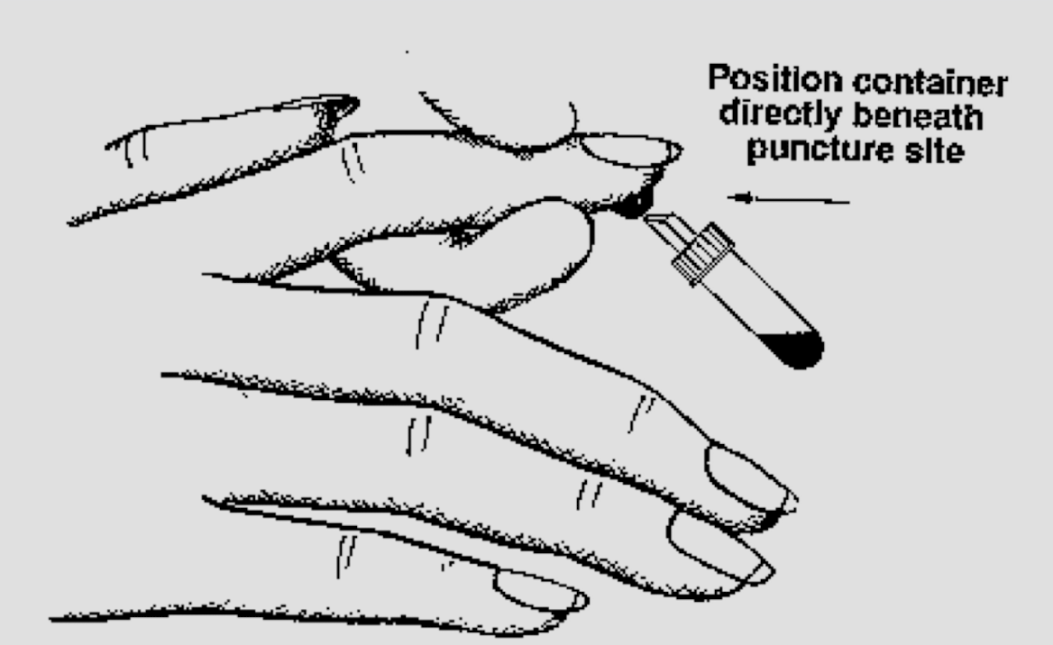 <p>positioned directly beneath puncture site, patient palm down</p>