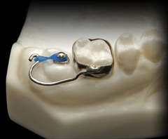 <p>what appliance for ectopically erupting permanent 1st molar:</p><p>- Distalizes the ectopically erupting permanent 1st molar so that it clears the primary 2nd molar and can erupt properly</p><p>- Band the E</p><p>- Bracket or button is bonded to the occlusal surface of the ectopically erupting 6</p><p>- Looped wire or c-chain applies a distalizing force</p><p>- Once the mesial of the 6 is clear, it will erupt on its own</p><p>- Also increases arch length</p>