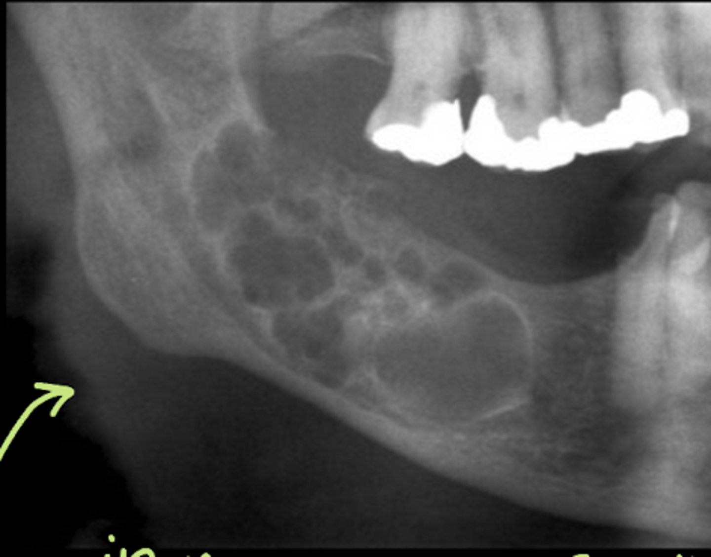 <p>- Density: radiolucent</p><p>- Internal architecture: unilocular or multilocular</p><p>- Effect on surrounding structure: root resorption</p>