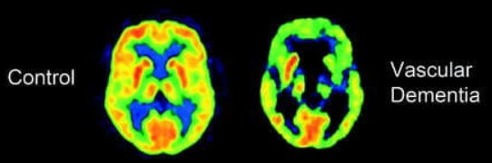 <ul><li><p>problemen bloedvoorziening in hersenen → afsterven cellen witte stof </p></li><li><p>beperkingen mogen niet samenhangen met lichamelijke beperkingen </p></li><li><p>vaak plots </p></li><li><p>trager denken </p></li><li><p>goed bewustzijn van problemen </p></li></ul><p></p>