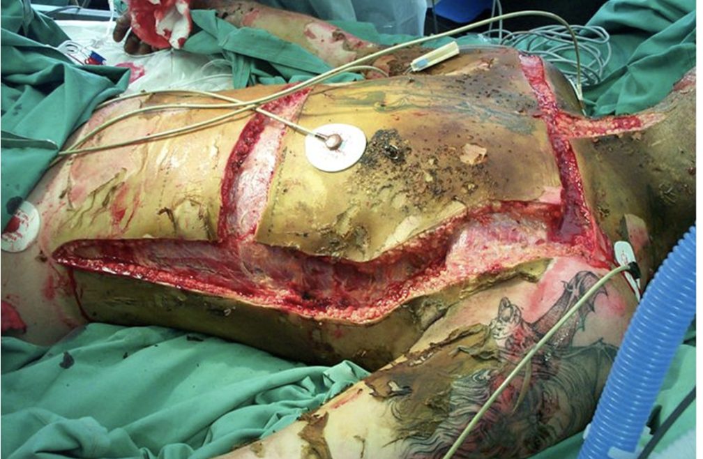 <p>escharotomy </p><ul><li><p>full-thickness burns will act like a tourniquet → super tight → your diaphragm and lungs cannot expant and contract </p></li><li><p>prophylactically or to release pressure and facilitate circulation </p></li><li><p>incision through eschar to expose subQ layer → incision will widen substantially b/c of all the pressure that’s being released </p></li></ul><p></p>