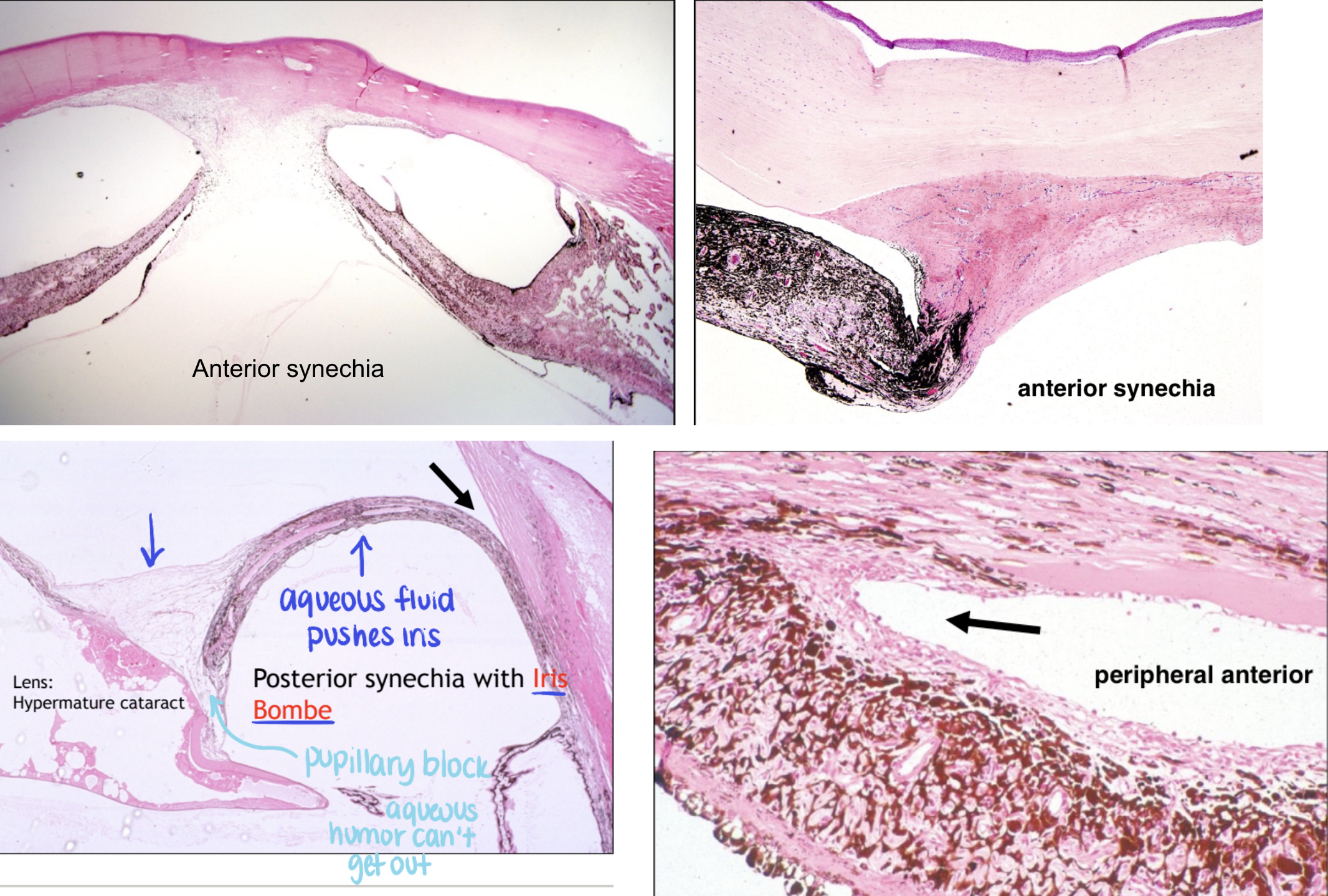 <ul><li><p><strong>anterior:</strong> adhesion to the cornea</p></li><li><p><strong>posterior:</strong> adhesion of the lens</p></li><li><p><strong>peripheral anterior:</strong> over the iridocorneal angle</p></li></ul><p></p>
