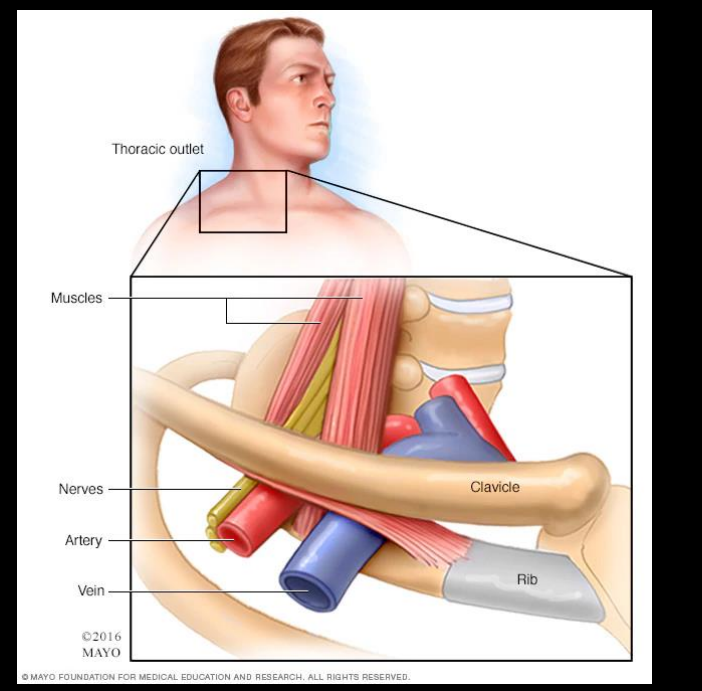 <p>Compression between 1st rib and scalene muscle </p><p> Compression between 1st rib and clavicle  </p><p>Compression between coracoid process and pectoralis muscle</p>