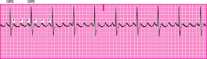 <p>Which rhythm is this?</p>