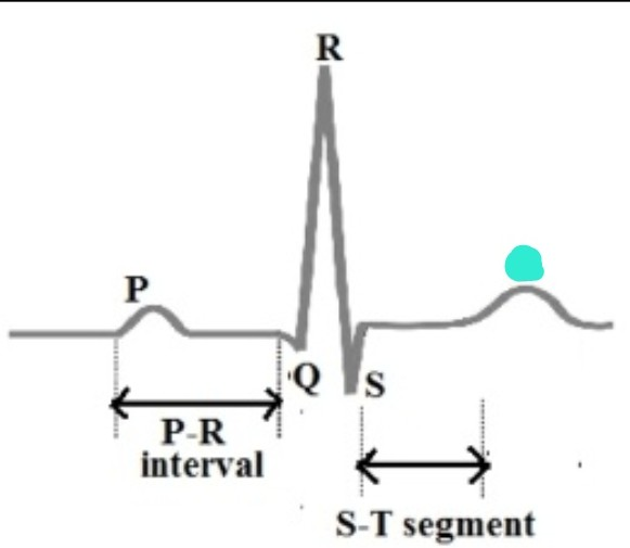 <p>ventricle의 repolarization 단계 반영 파형, ventricle 이완 단계</p>