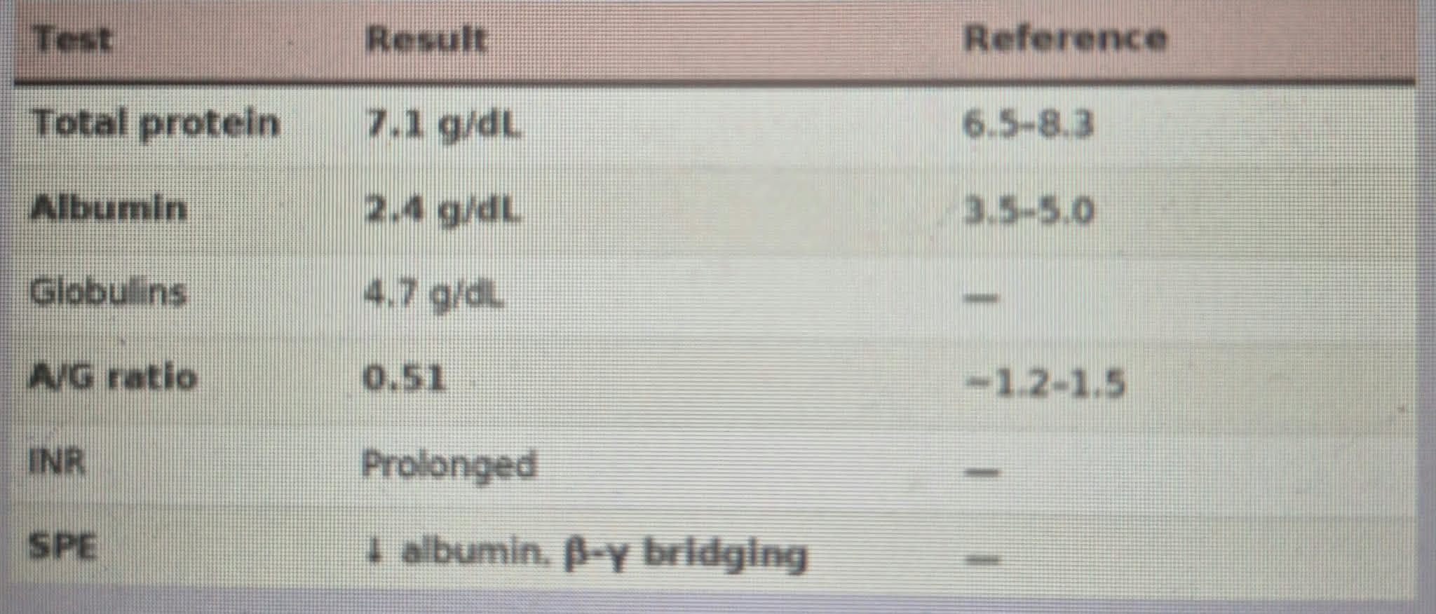 <p>CASE 5: </p><p>A 58-year-old man with a long history of alcohol use </p><p>presents with abdominal distension and easy bruising. </p><p>Questions: </p><p>1. Why is the total protein normal despite a </p><p>markedly low albumin? </p><p>2. Why are the globulins raised if the liver is failing?</p><p>3. What causes the bruising? </p>