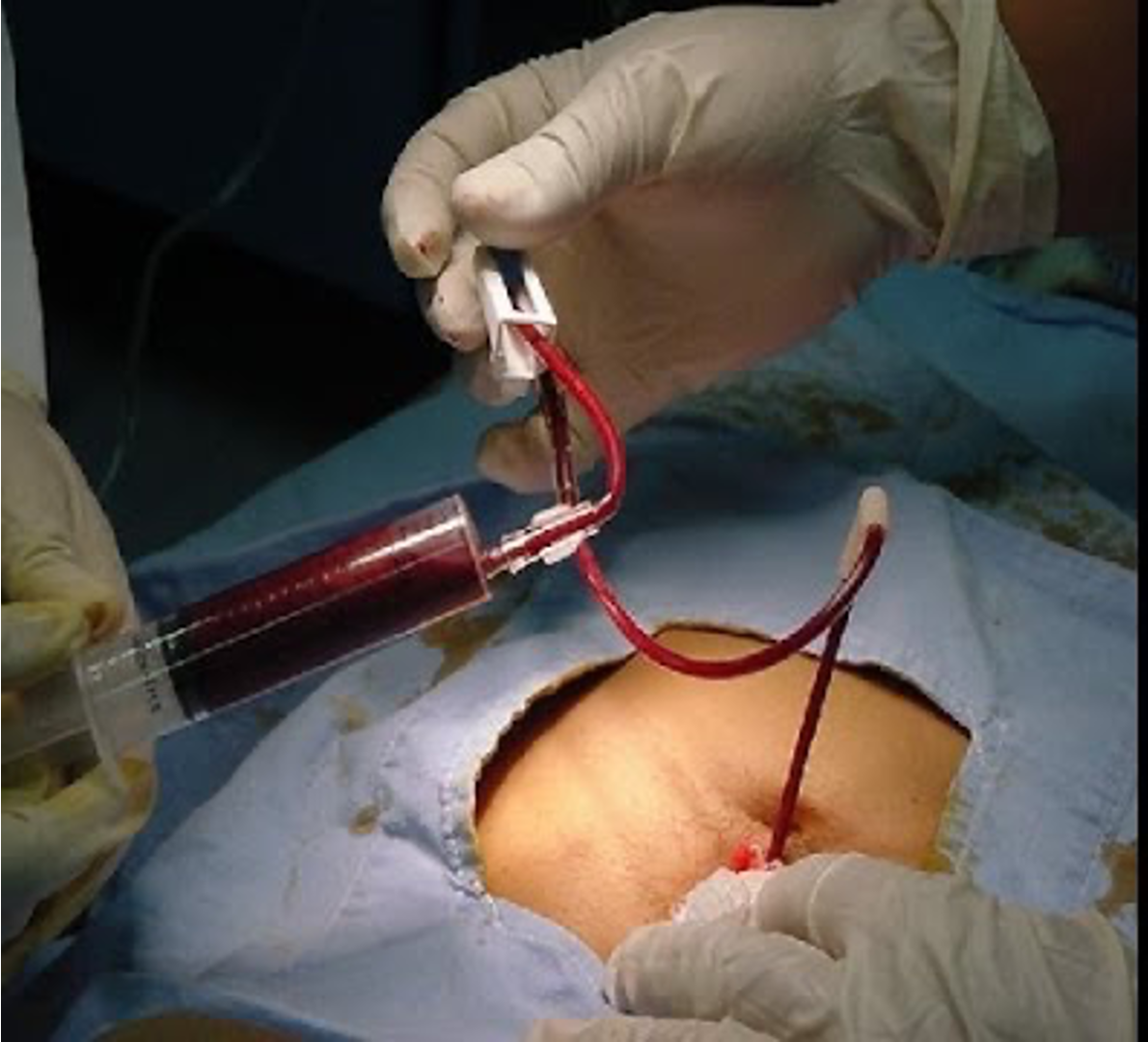 <p>Diagnostic Peritoneal Lavage (DPL)</p>