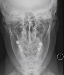 <p><span style="background-color: transparent;">Mandible - Towne</span></p>