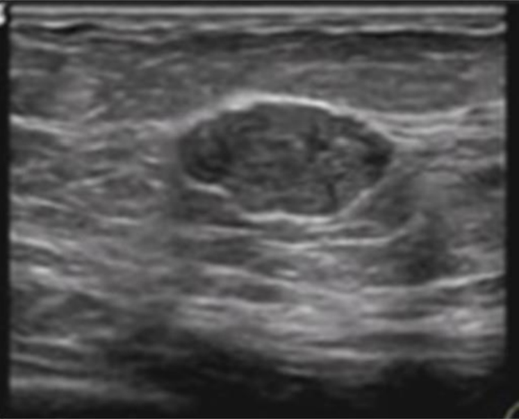 <p>What is the pathology on this breast US</p>