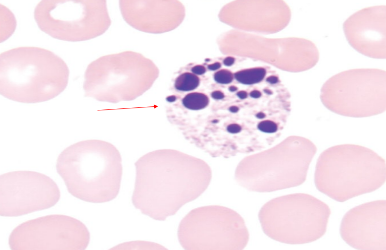<p>what is a pyknotic nucleus?</p>