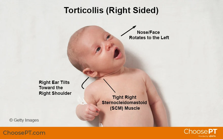 <ul><li><p><span style="background-color: transparent; font-family: "Times New Roman", serif;">Stiff neck</span></p></li><li><p><span style="background-color: transparent; font-family: "Times New Roman", serif;">Muscle spasm</span></p></li><li><p><span style="background-color: transparent; font-family: "Times New Roman", serif;">Lateral flexion</span></p></li></ul><p></p>