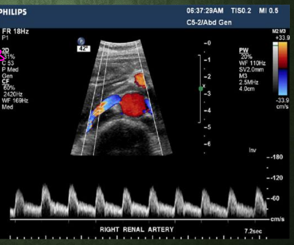 <p>What is the normal renal artery PSV range?<br>→ 100–150 cm/sec</p><p>What RI range is considered normal?<br>→ 0.5–0.7</p><p>What type of waveform is normal in renal arteries?<br>→ Low resistance waveform</p>