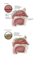 <p>inflammation of the nose and sinuses</p>