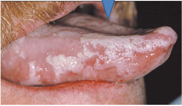 <p>1.what is this lesion?</p><p>2. how to treat/ manage it?</p><p>3. classification of oral lesion in HIV?</p>