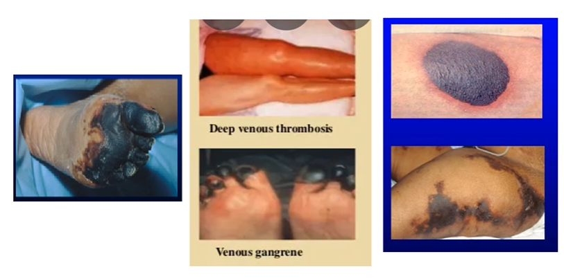 <p>You will have thrombosis like DVT, venous gangrene and you stop the heparin and start non heparin agent like Direct Thrombin Inhibitors (Argatroban)<br>Direct Oral anticoagulants (Apixaban)</p>
