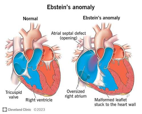 <p>ebstsein's anomaly</p>