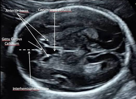 <p>“Box shaped” structure in axial/transverse plane</p><p>Should be seen between 18 and 37 weeks</p>