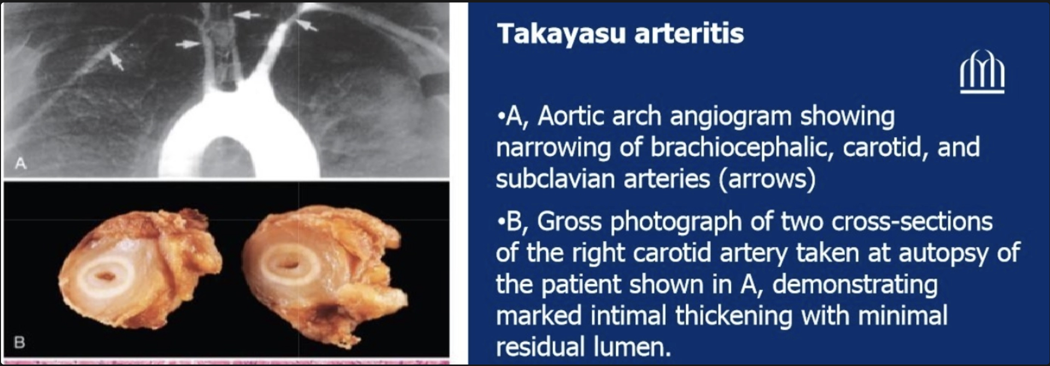 <p>Irregular thickening of vessel wall with intimal thickening; great vessel lumens markedly narrowed or obliterated</p>