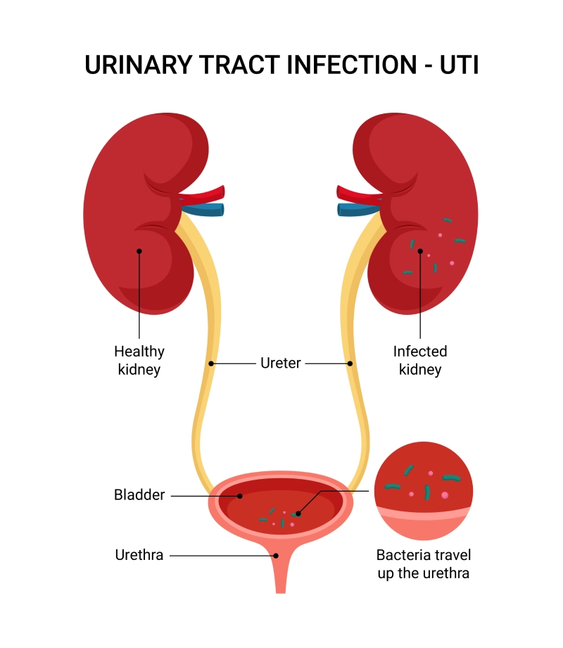 <p>UTI is a bacterial infection of the ______, bladder, ureter, or kidney.</p>