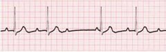 <p>"Wenckebach"</p><p>"Longer, Longer... drop" prolonged PR intervals and the missing QRS</p>
