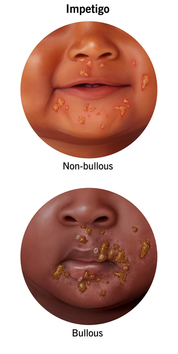 <p>Crusting (nonbullous) sores spread from one body part to another ; can be caused by Streptococcus pyogenes or <span style="font-size: calc(var(--scale-factor)*18.00px);">Staphylococcal</span></p>