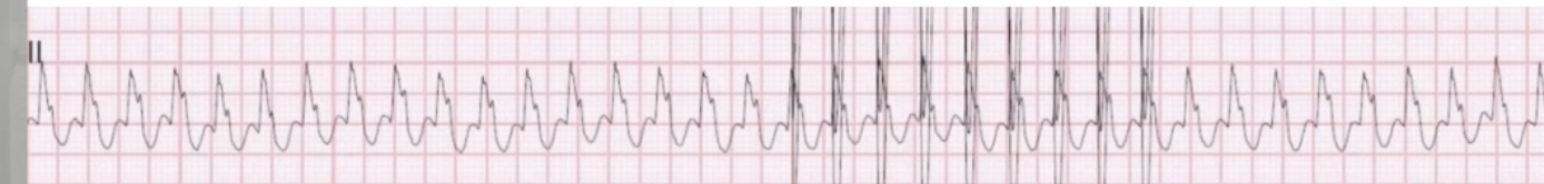 <ul><li><p>VT, SVT with aberrancy, or antidromic AVRT?</p></li><li><p>12 lead: AV relationship, axis, R wave progression, durations</p></li><li><p>EGMs: more difficult</p><ul><li><p>Don't assume one or the other</p></li><li><p>Physician may want additional testing</p></li></ul></li></ul><p></p>