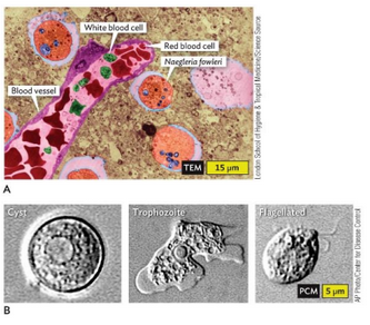 <p>Naegleria meningoencephalitis</p>