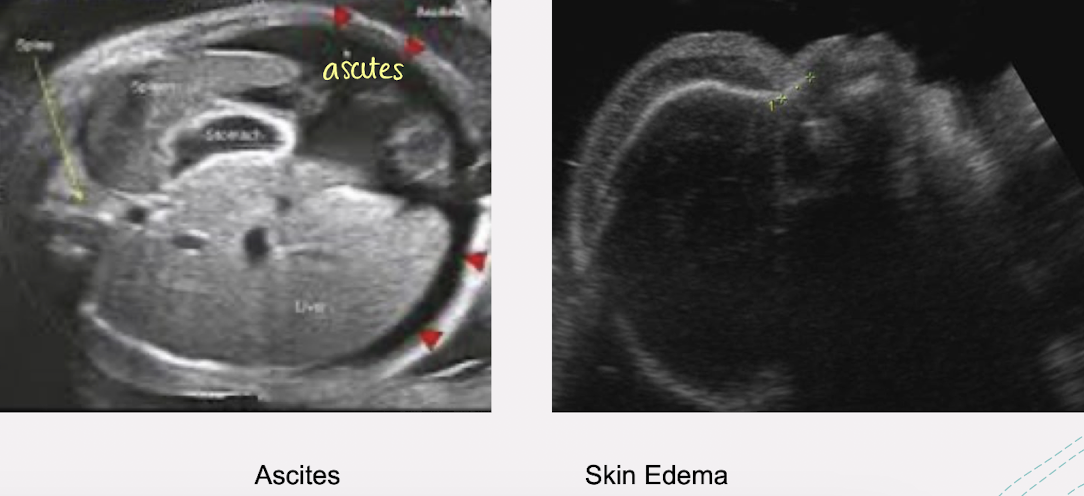 <ul><li><p>in severe cases, this condition can cause serious complications such as</p><ul><li><p>polyhydramnios </p></li><li><p>placental edema</p></li></ul></li></ul><p></p>
