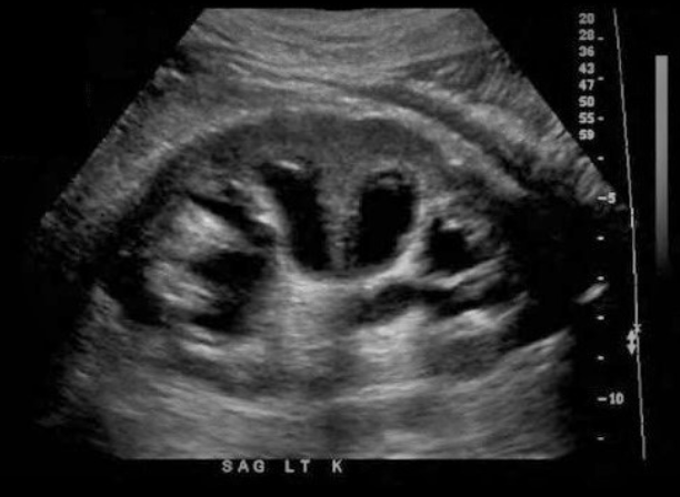 <p>Which of the following statements is true regarding the image displayed?</p><p>a. a staghorn calculus is seen in the central pelvis of the kidney causing hydronephrosis</p><p>b. the BUN and creatinine serum levels will be decreased due to decreased renal function</p><p>c. the patient will present with a fever and increased WBC count</p><p>d. the renal cortex is thinned and increased in echogenicity</p>