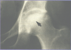 <p>The plain radiograph of any site affected by osteonecrosis can remain normal for months after symptoms begin; the earliest findings are mild density changes followed by sclerosis and cysts as the disease progresses.</p>