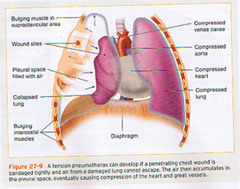 <p>B. pneumothorax</p>