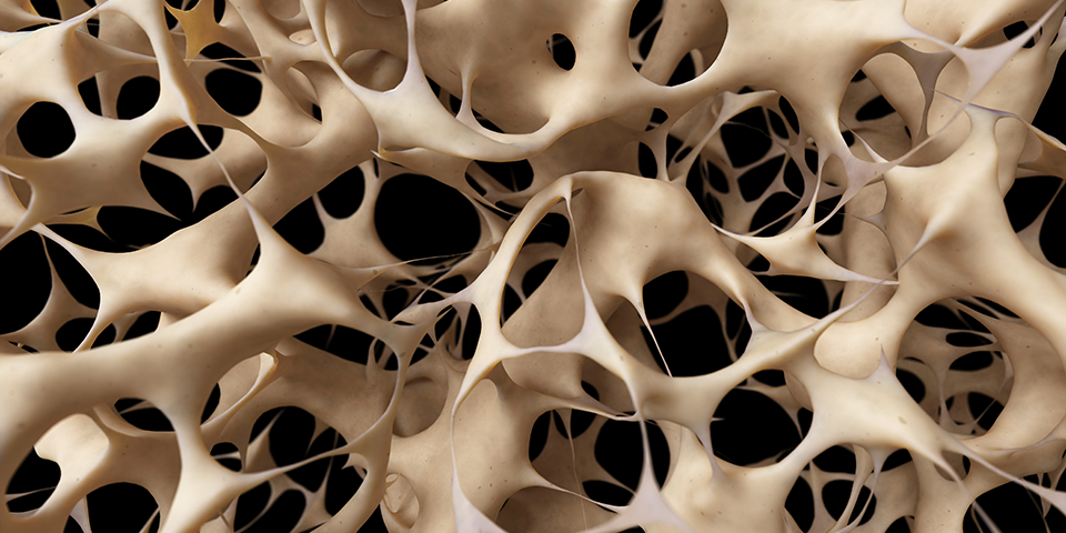 <p>Osteosis Tissue </p>